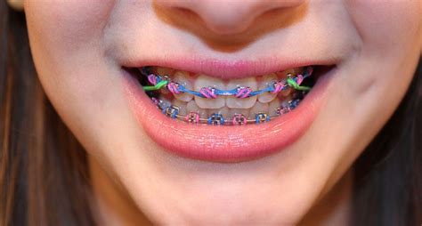 Why Do You Need To Know About Different Types Of Braces