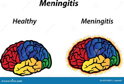 Meningitis Vector Illustratie Illustratie Bestaande Uit Geestelijk