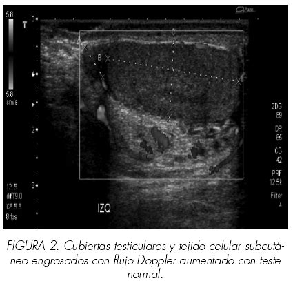 Edema del escroto agudo idiopático Presentación de dos casos