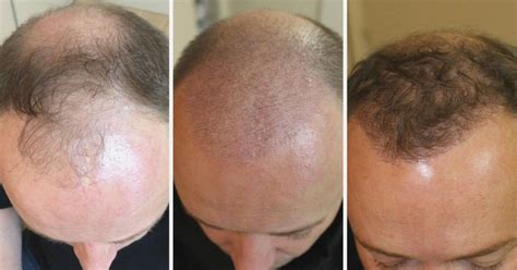 Comment choisir son chirurgien pour une greffe de cheveux à Paris