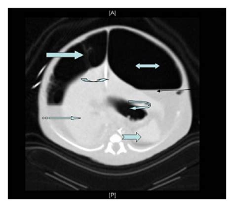 Abdominal Ct Scan Image Showing Abundant Intraperitoneal Space