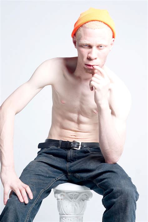 Pin On Albinism