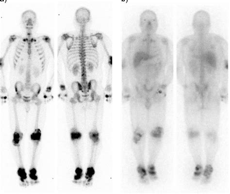Figure4whole Body Scintigraphy A 99m Tc Hmdp Bone Scintigraphy B