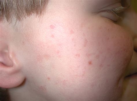 A Kid With Kp On The Face Keratosis Pilaris Treatment Options