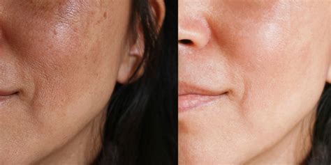 What You Should Know About Melasma Those Dark Spots On