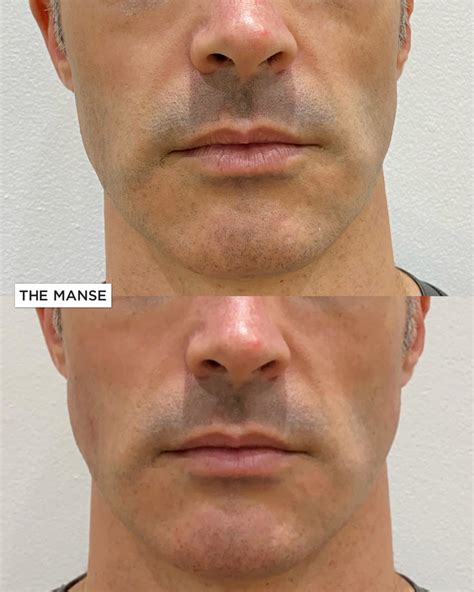 Jawline Filler Experienced Doctors At Our Sydney Clinic