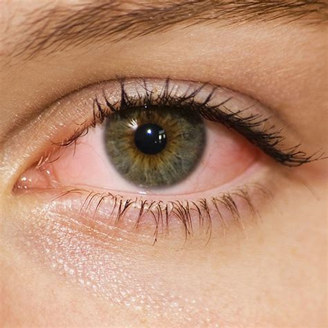 The Basics Of Pink Eye Omaha Ne Exclusively Eyecare