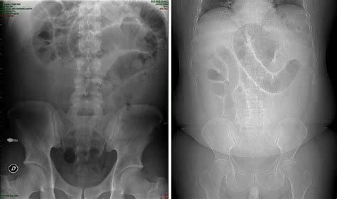 Plain Abdominal X Ray Films Showing A Proximal Small Bowel Obstruction