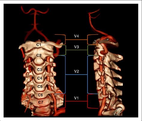 Vertebral Artery Segments V Through V Case Courtesy Of Dr Robert Download Scientific