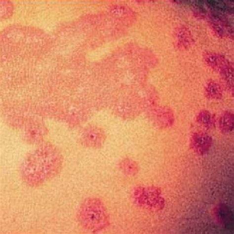 Maculopapular Rashes Seen On The Palms Of The Patient Download