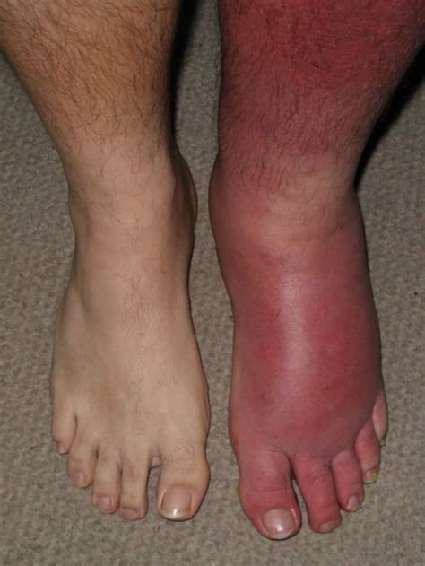Cellulitis And Erysipelas Its Red Its Swollen Its Tender
