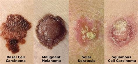 Skin Cancer Northshore Dermatology