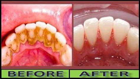 Walmart.com has been visited by 1m+ users in the past month How To Clean Yellow Teeth Naturally and Remove Dental ...