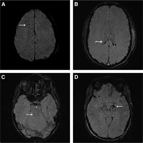 Diffuse axonal injury after traumatic cerebral microbleeds: (A) Diffuse axonal injury (DAI) stage I: susceptibility ...