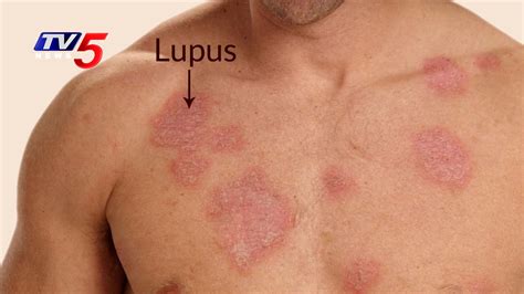 Lupus Disease Systemic Lupus Erythematosus Nature Reviews Disease