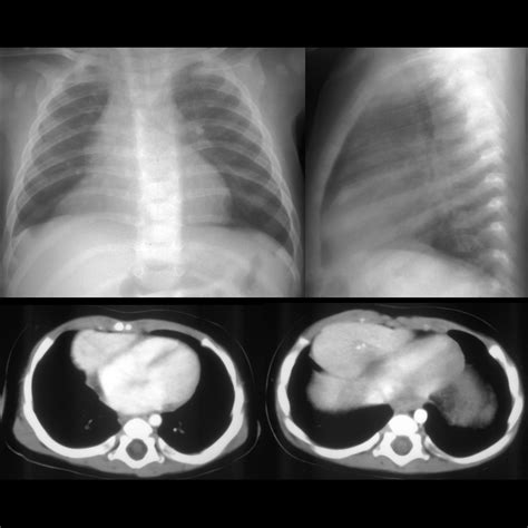 Pediatric Diaphragm Eventration Pediatric Radiology Reference Article