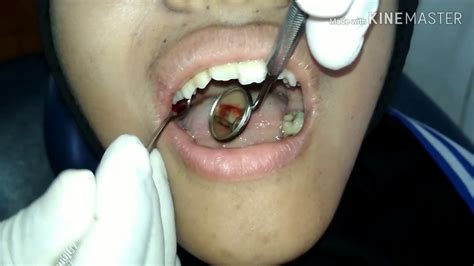 Gigi ini diberi nama geraham bungsu karena tumbuhnya belakangan. Pencabutan Gigi Geraham Atas|Polip Gigi|Tooth Extraction ...