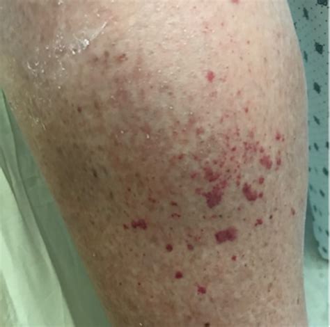 Cutaneous Manifestations Associated With Covid 19