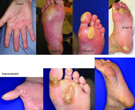 The Hand‐foot‐syndrome Associated With Medical Tumor Therapy