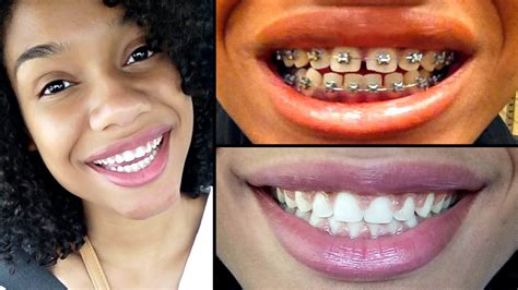 How Much Time Does It Take To Get Braces Off Apps Trends Plex