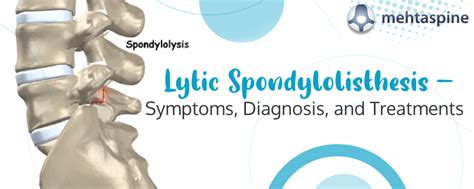 Diagnosis And Treatment Of Lytic Spondylolisthesis