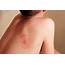 View Itchy Rash Joint Pain Background  Propranolols