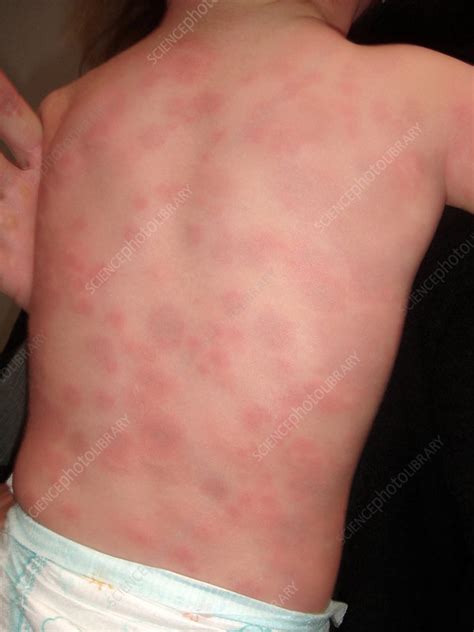 Urticaria Stock Image C0384476 Science Photo Library