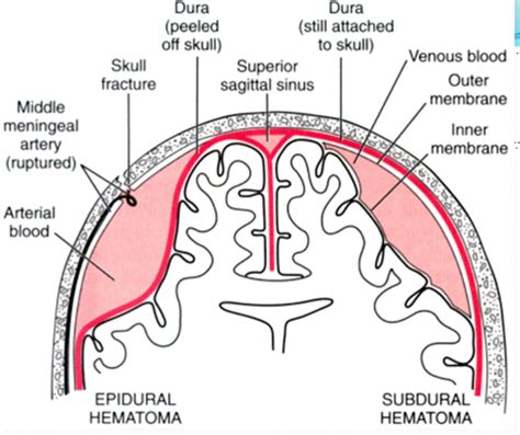 Treatment of acute subdural hematoma. MBBS Medicine (Humanity First): Images for Epidural ...