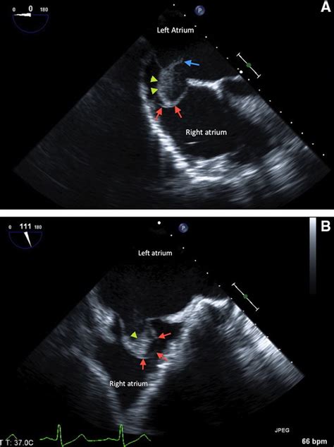 A Teapot Atrial Septal Aneurysm With Spontaneous Thrombus In An