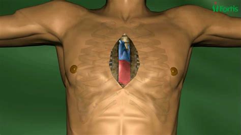 Endoscopic Mitral Valve Repair Minimally Invasive Cardiac Surgery