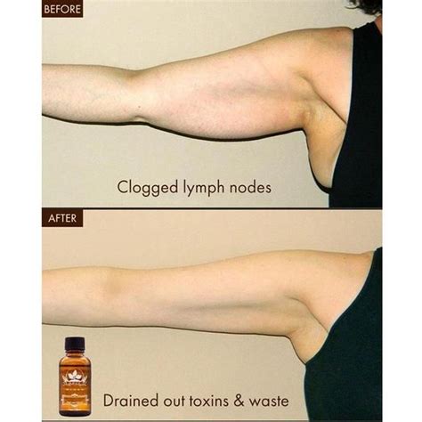 Lymphatic Drainage Ginger Oil Zevymo With Images Lymphatic