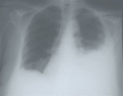 Pleurisy In Chest X Ray Various Radiographs To Show And Depict This