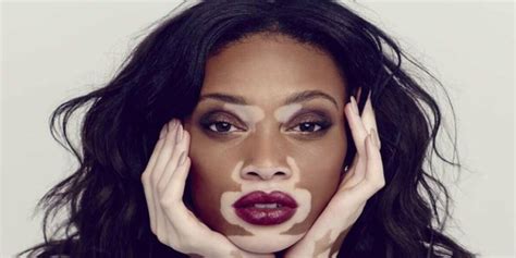 Vitiligo Is A Skin Disease That Causes The Formation Of White Spots Newz
