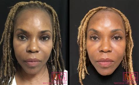 African American Skin Treatment And Dermatology Nyc Dr Michele Green Md