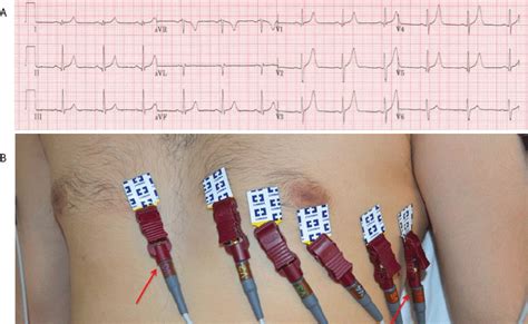 Common Ecg Lead Placement Errors Part Ii Precordial Misplacements