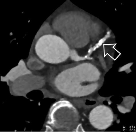 Evaluation Of Heavily Calcified Vessels With Coronary CT Angiography Comparison Of Iterative