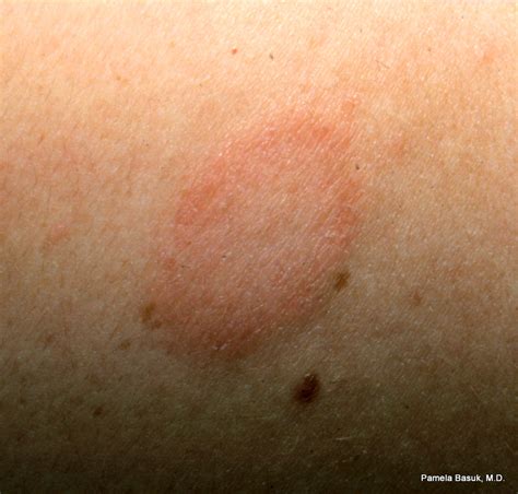 Pityriasis Rosea On Back