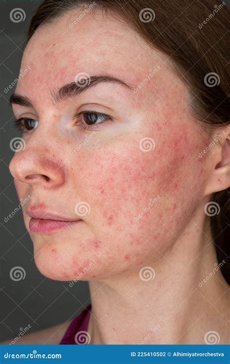 Rosacea Face The Girl Suffers From Redness On Her Cheeks Couperosis