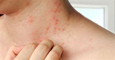 Dermatitis Causes Symptoms And Treatment
