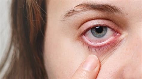 Eye Eczema What Is Eyelid Dermatitis Know All About Triggers Warning