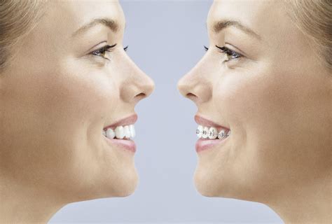 Orthodontics In Canberra Evolving Smiles