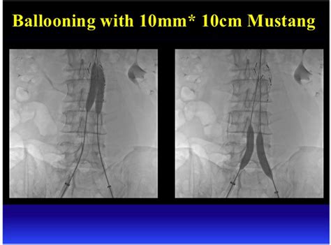 Tctap C 053 Sac Regression After Endovascular Relining Of Perigraft