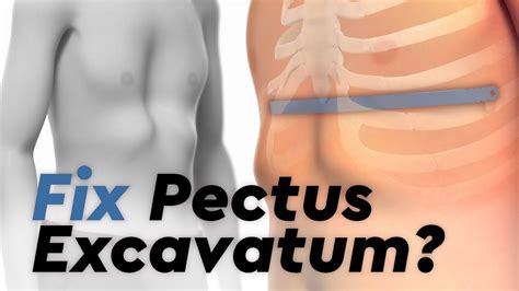Pectus Excavatum And The Nuss Procedure Youtube