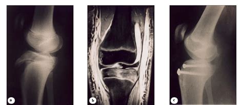 Figure From Avulsion Fractures Of Tibial Tuberosity In Adolescents