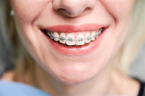 Quanto Tempo Leva Para Alinhar Os Dentes Com Aparelho