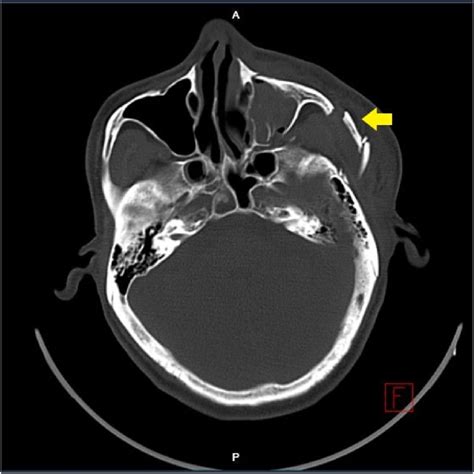 A Fracture Of The Left Cheekbone Is Revealed By Computed Tomography Of