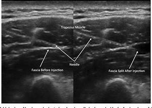 Figure 4 From Myofascial Trigger Points New Insights In Ultrasound