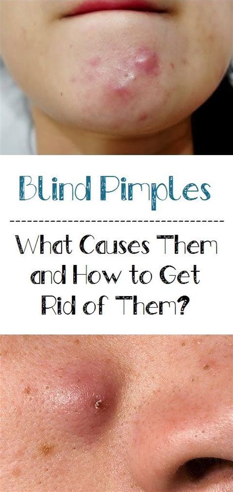 Blind Pimples What Causes Them And How To Get Rid Of Them Blind