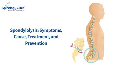 Spondylolysis Symptoms Cause Treatment And Prevention Best Back