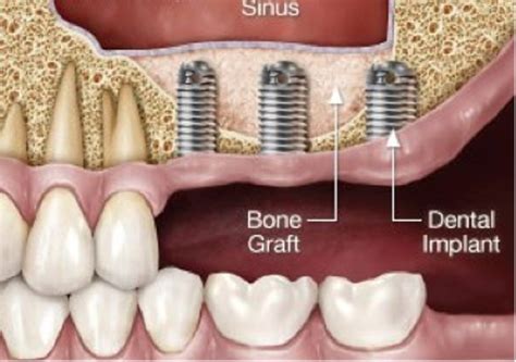 Sinus Lifts Or Sinus Bypass Dental Implant Speciality Centre
